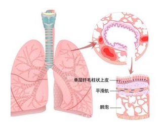职业性哮喘的症状有哪些